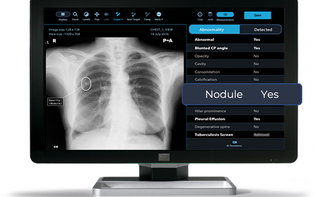 Unilabs signs on Qure.ai for triaging chest X-rays